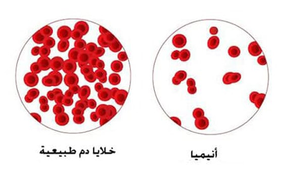 مش الأكل بس.. تعرف على أمراض تسبب فقر الدم والأنيميا صورة رقم 2